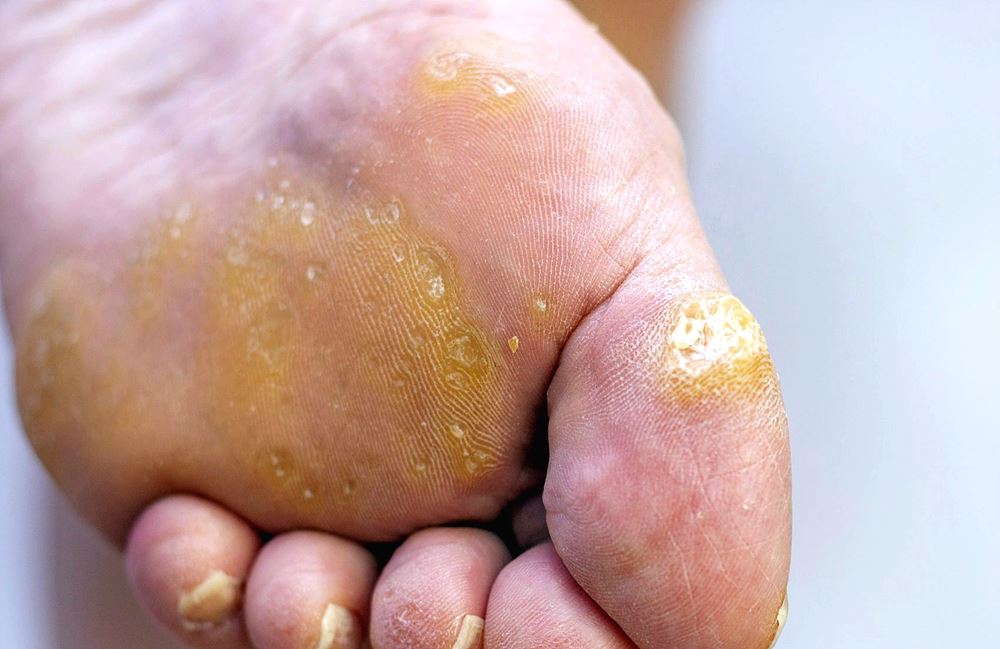 집에서 할 수 있는 사마귀 제거 방법