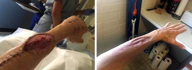 급성구획증후군 치료 방법