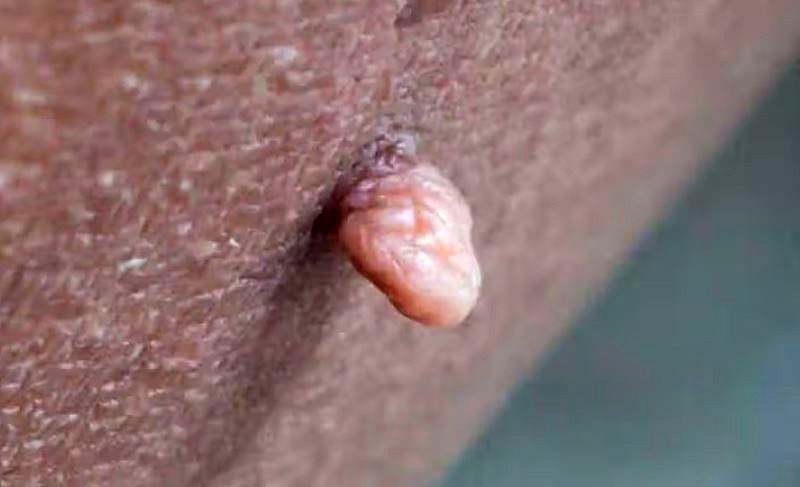 쥐젖 제거 방법, 집에서도 안전하게 할 수 있을까?